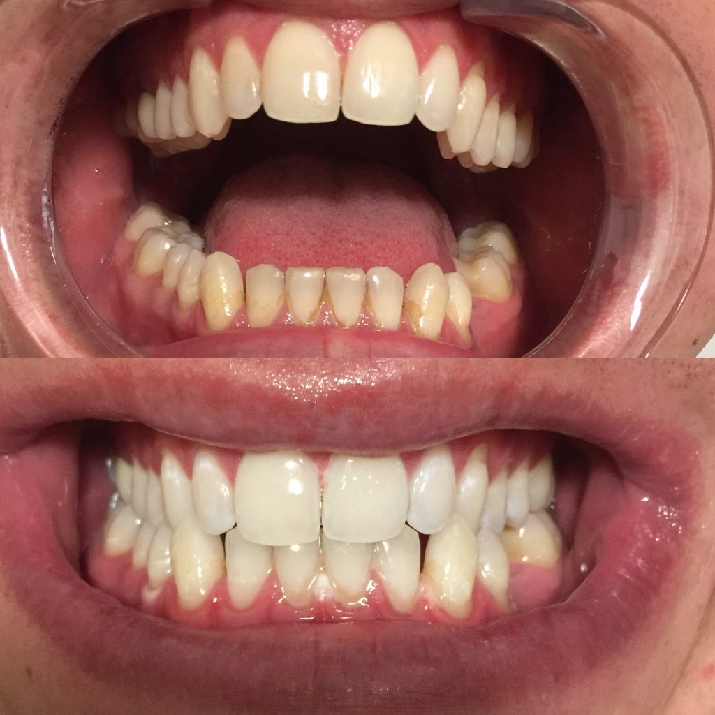 Teeth Whitening Willow Grove