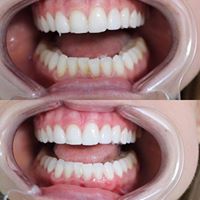 Self applied Professional Teeth Whitening Willow Grove Pa 
