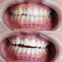 Self applied Professional Teeth Whitening Willow Grove Pa 