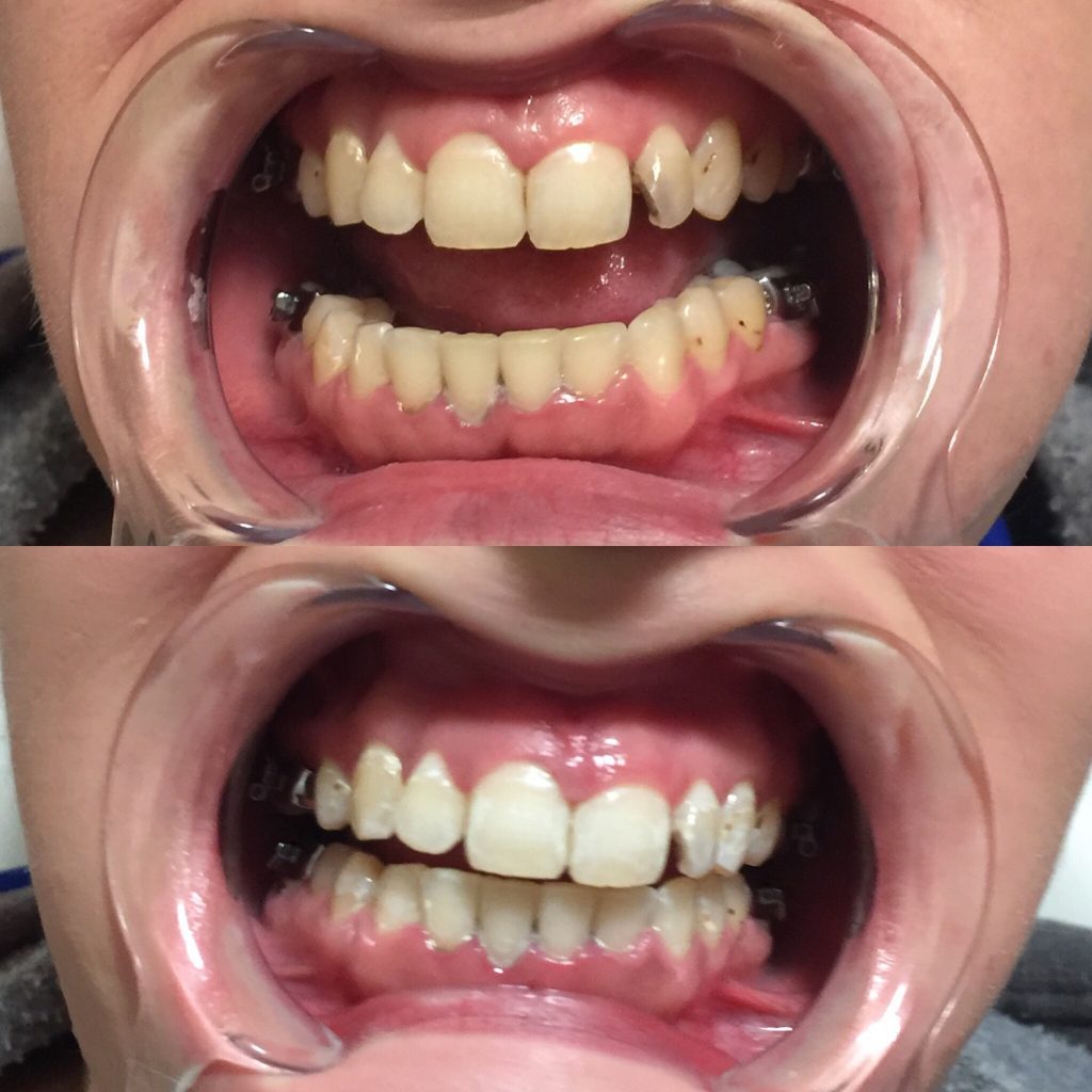 Teeth Withening